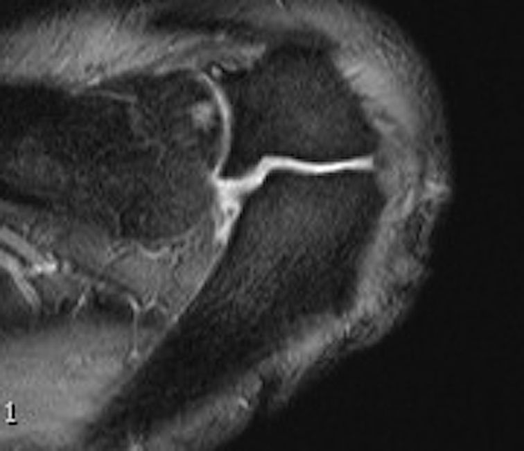 Os Acromionale MRI Axial
